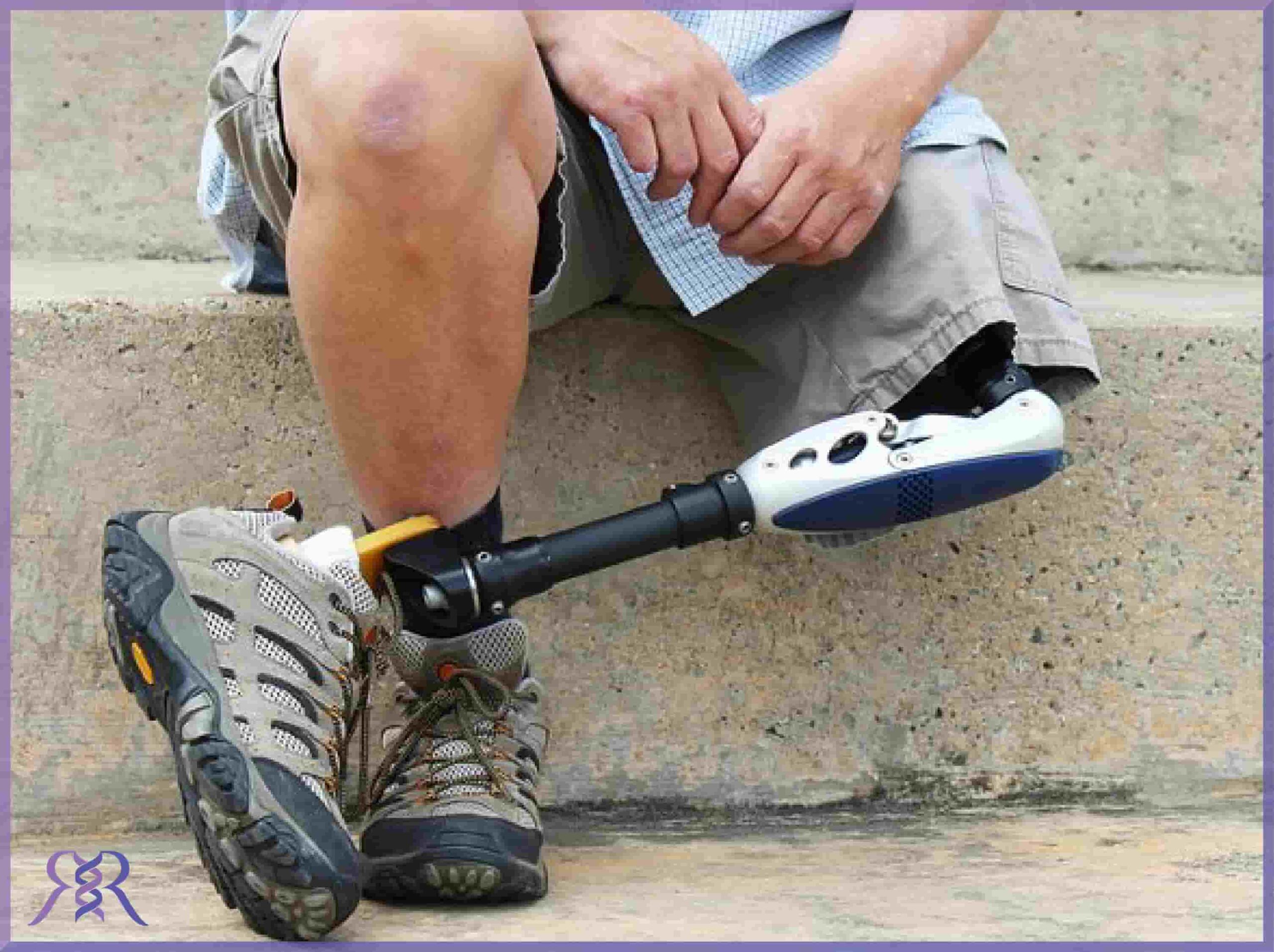 معایب استفاده از پروتز بالای زانو