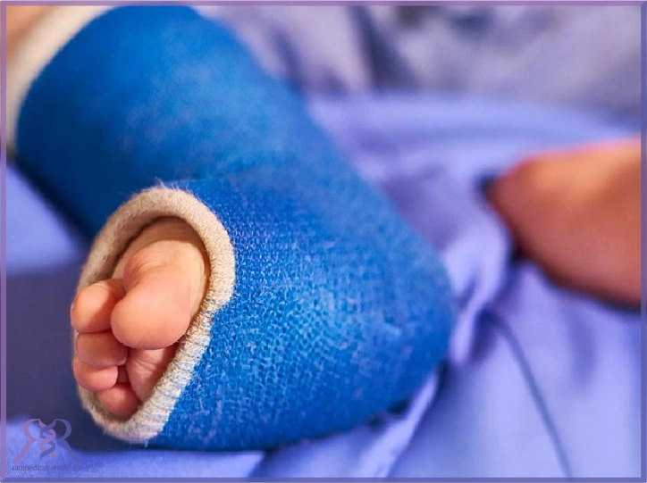 درمان کلاب فوت در بزرگسالی