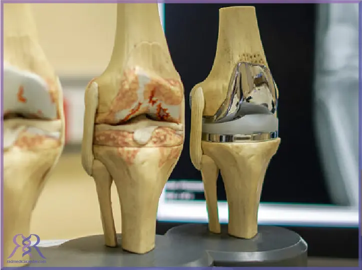 3 تا از بهترین مارک های پروتز زانو