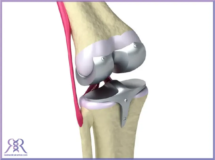 نکاتی در خصوص انتخاب بهترین برند پروتز زانو