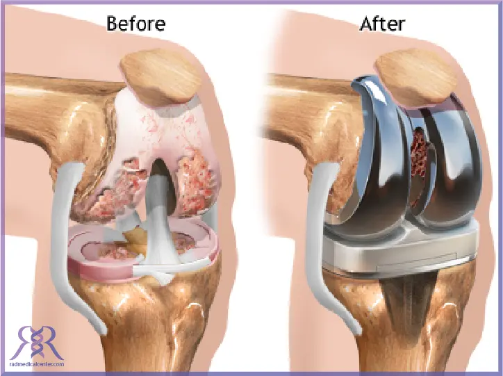 بهترین مارک پروتز زانو