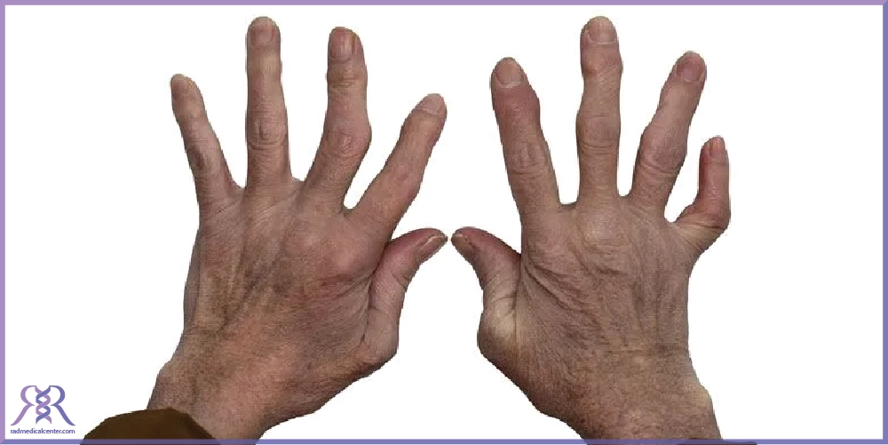 تشخیص آرتروز