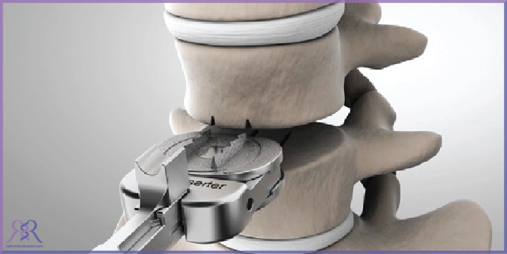 پروتز گردن چیست؟