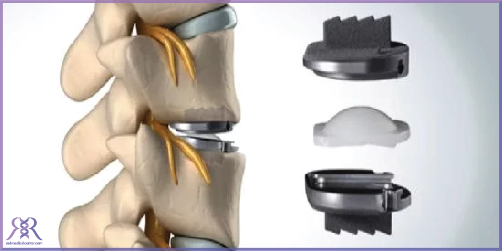 عوامل موثر بر قیمت پروتز گردن