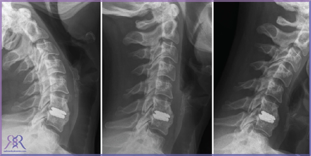تفاوت پروتز گردن با فیوژن گردن