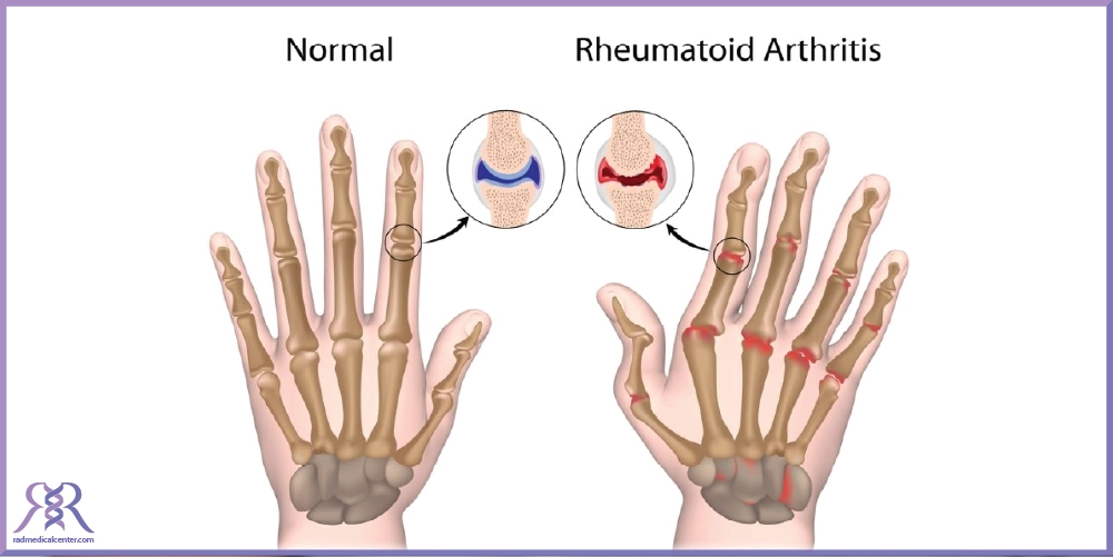 علائم بروز آرتروز در بدن