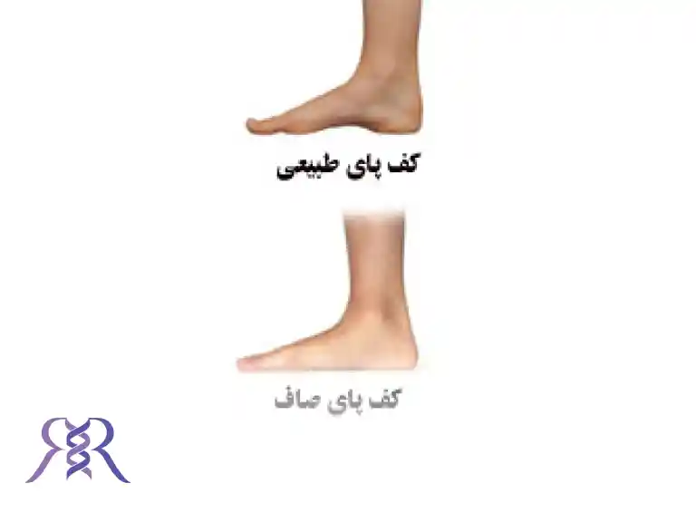 عوارض کف پای صاف