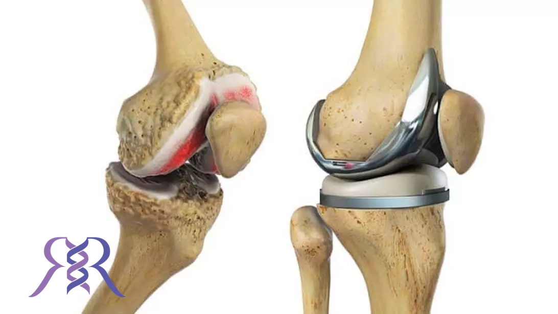 درمان عفونت پروتز زانو