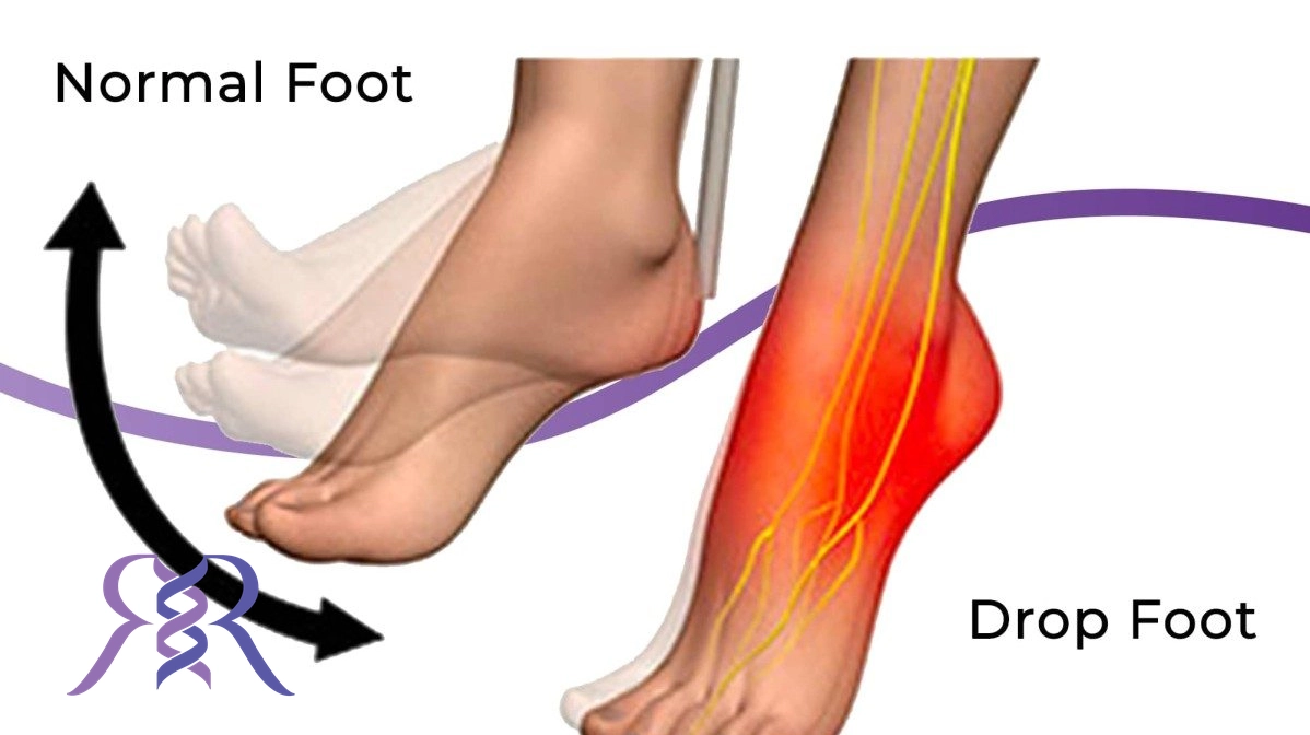 افتادگی مچ پا