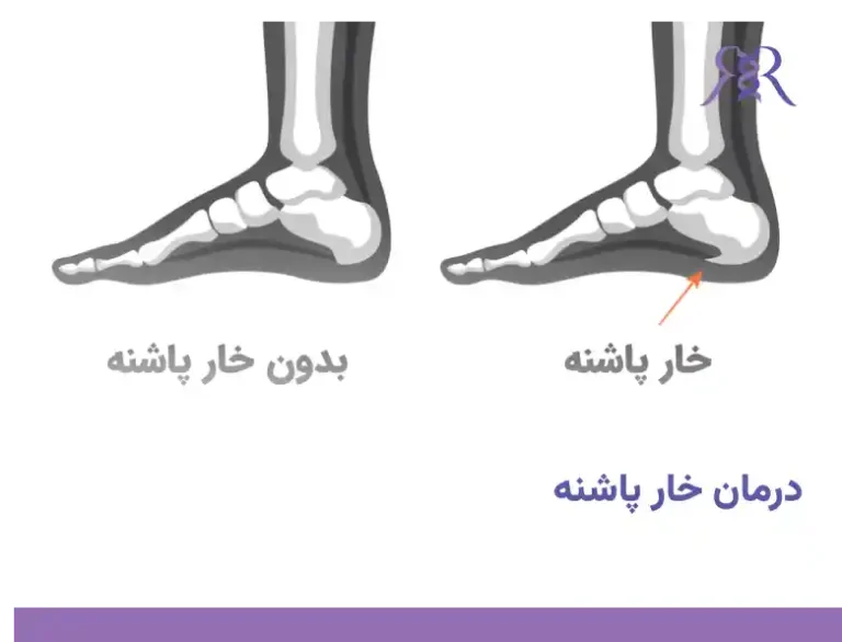 درمان خار پاشنه