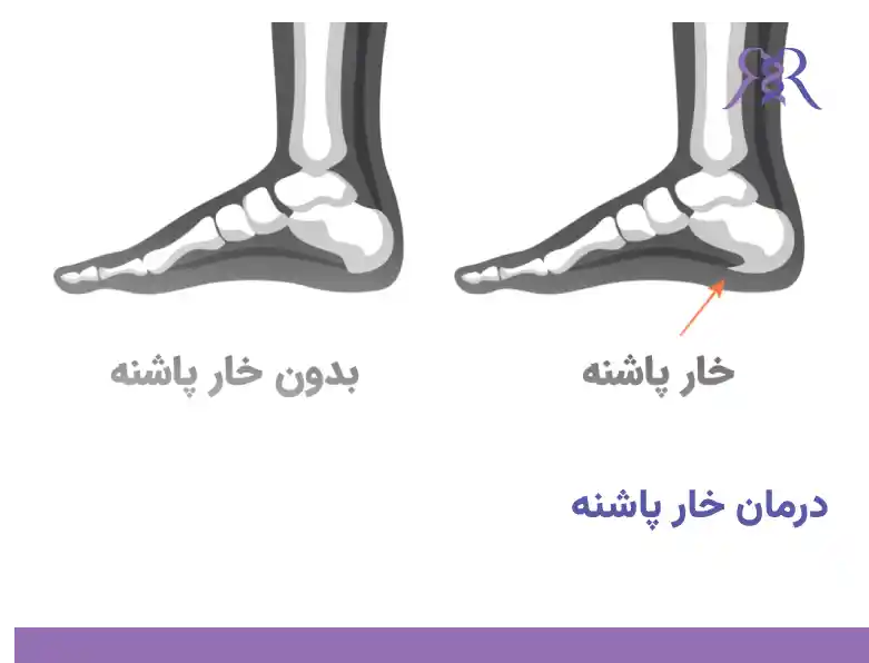 درمان خار پاشنه