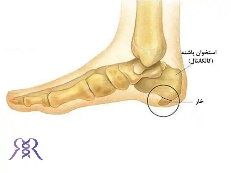 درمان خار پاشنه