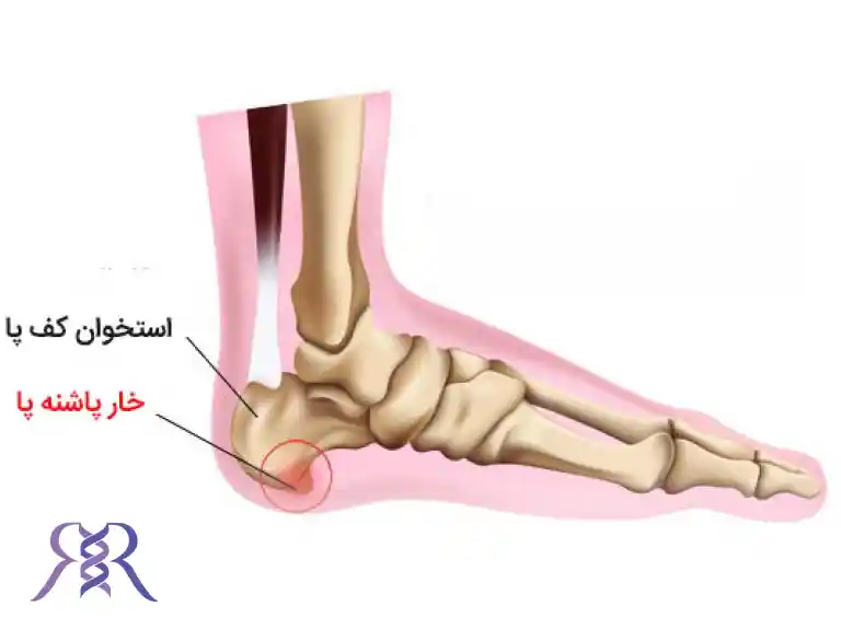 درمان خار پاشنه 
