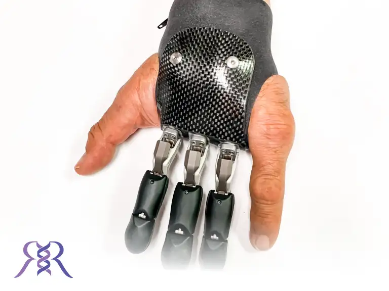 finger prosthetic installation