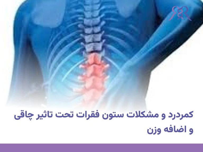 کمردرد و مشکلات ستون فقرات تحت تاثیر چاقی و اضافه وزن