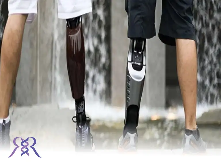 هر آن چه که باید در انتخاب پروتز بالای زانو رعایت کنید