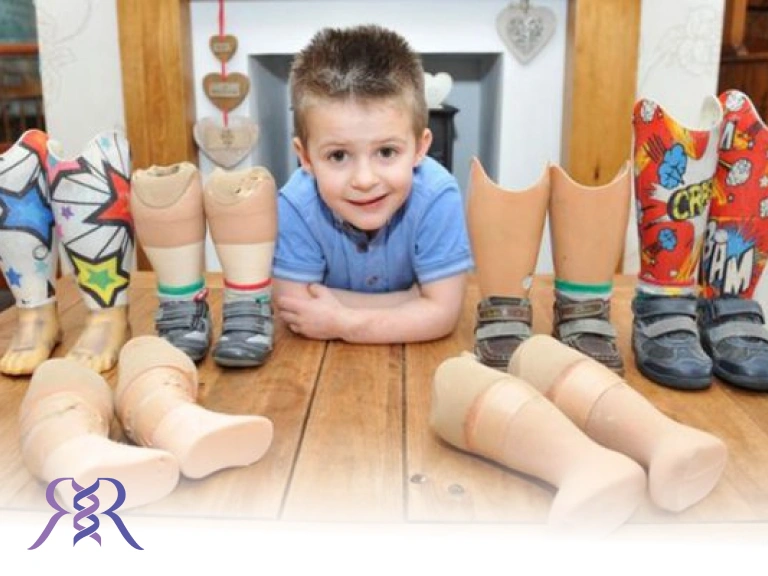 چگونه کودکان را آماده نصب پروتز زیر زانو کنیم؟