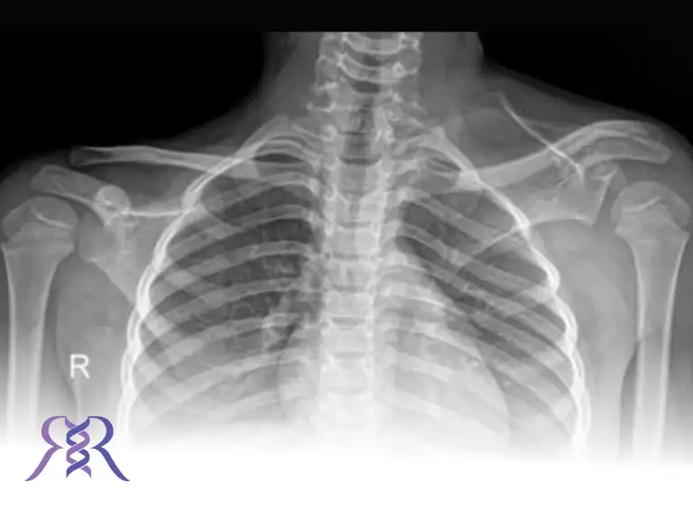 بالا بودن مادرزادی شانه یا کتف (اسپرینگل)