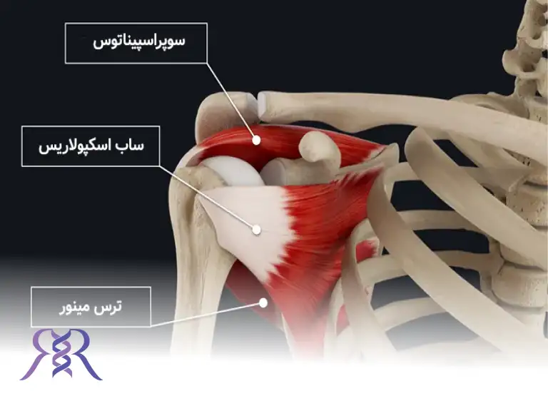 پارگی تاندون شانه (روتاتور کاف)