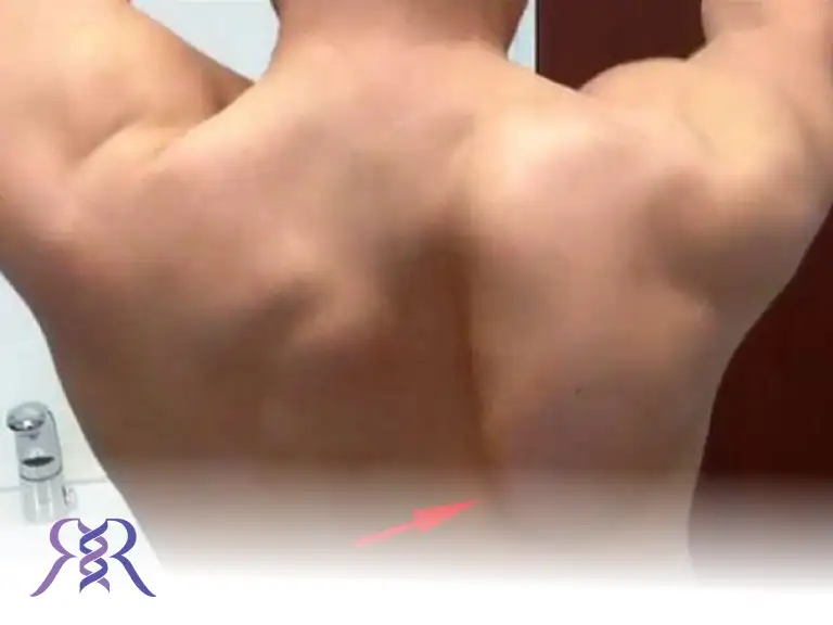 بالا بودن مادرزادی شانه یا کتف (اسپرینگل)