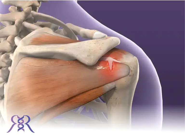 پارگی تاندون شانه (روتاتور کاف)