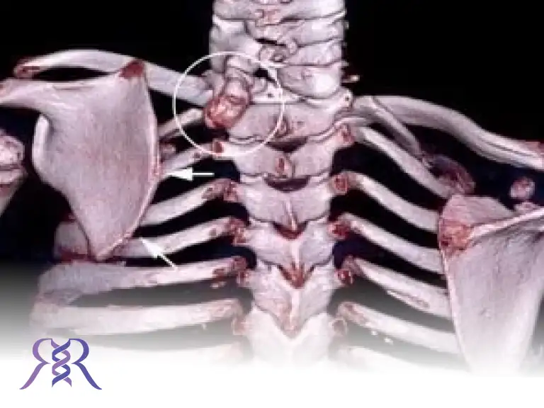 بالا بودن مادرزادی شانه یا کتف (اسپرینگل)