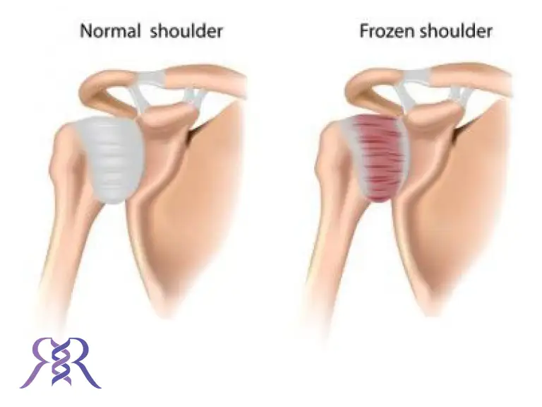 شانه یخ زده. علائم و درمان