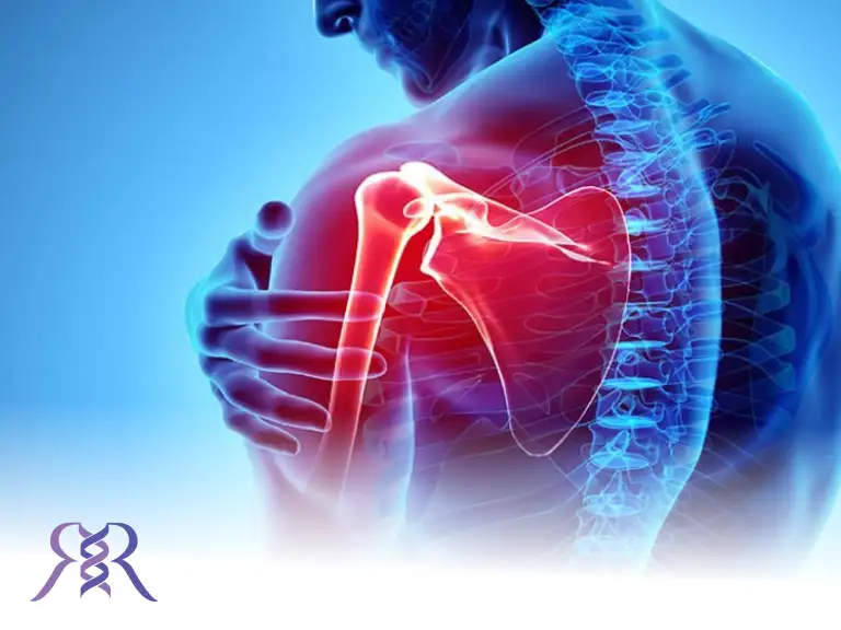 پارگی تاندون شانه (روتاتور کاف)