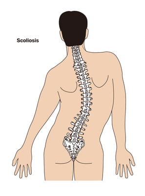 اسکولیوز چیست و چطور با بریس، روند انحنا کنترل میشود؟