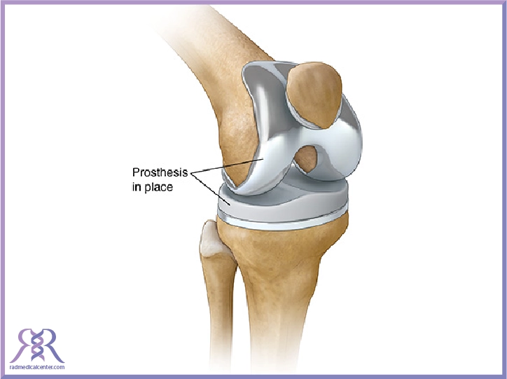 انواع پروتز زانو