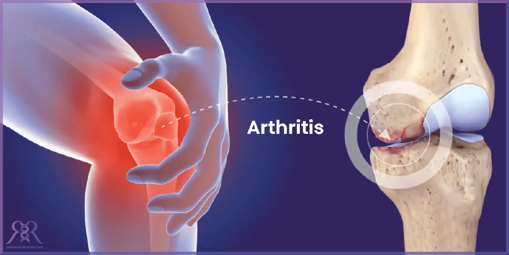 آرتروز مفاصل چیست