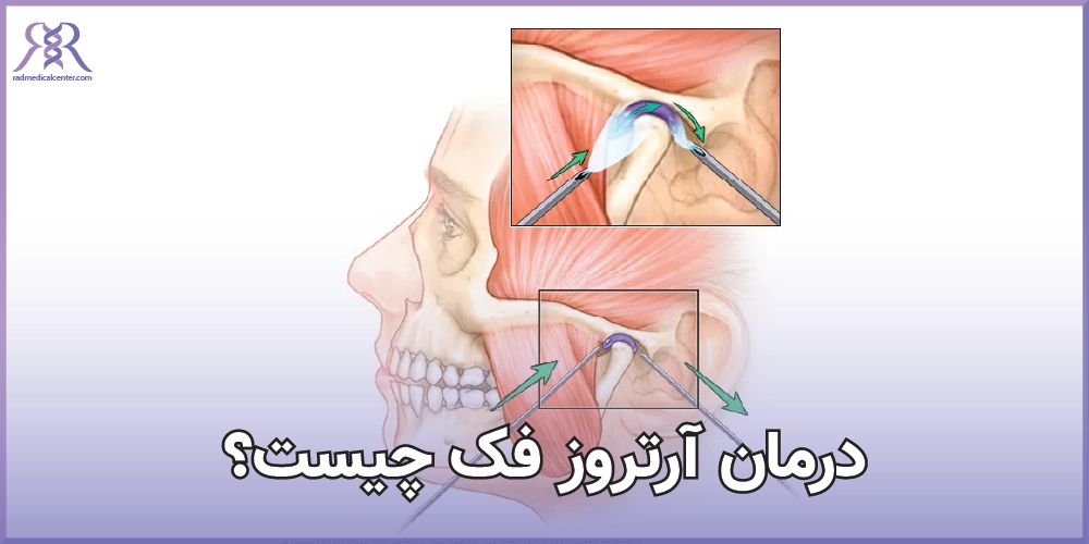 درمان آرتروز فک چیست