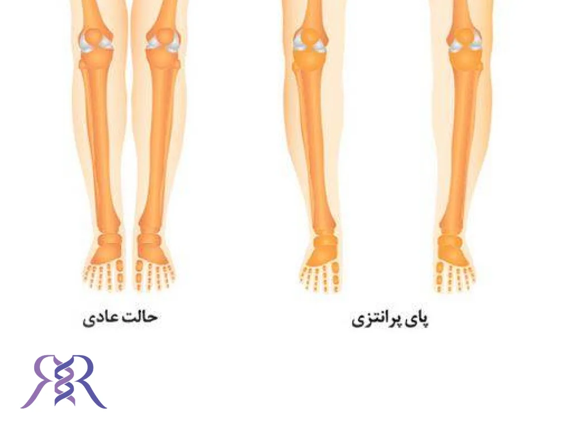 کفش طبی برای پای پرانتزی