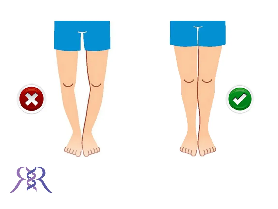 کفش طبی برای پای پرانتزی