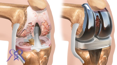 پروتز مفصل زانو