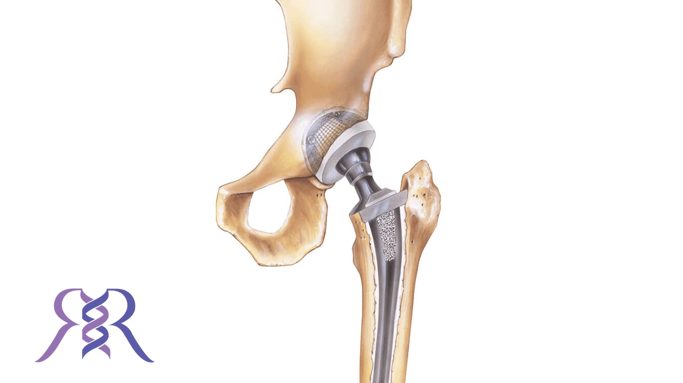 مراقبت های بعد از عمل تعویض مفصل لگن