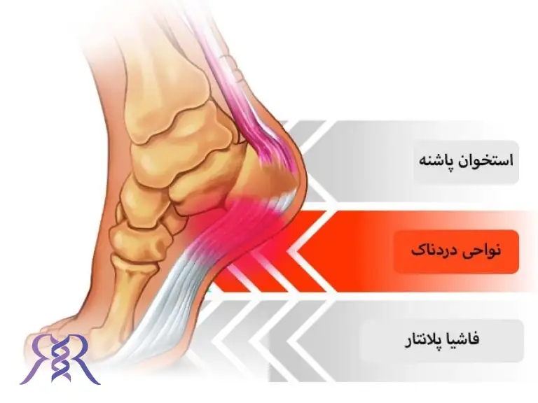 درمان خانگی خار پاشنه