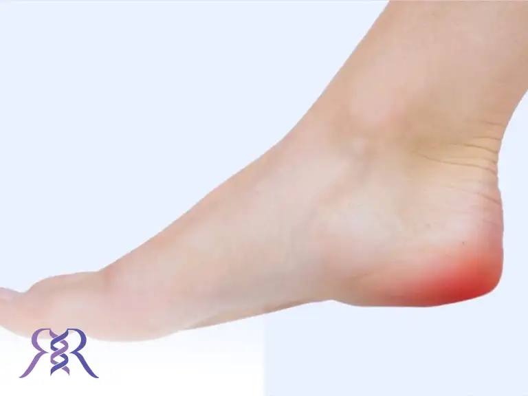 درمان خانگی خار پاشنه