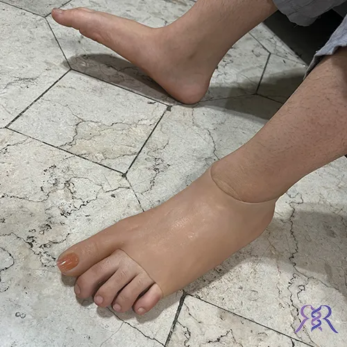  پروتز قطع عضو